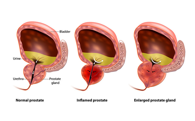 Understanding Enlarged Prostate: Causes, Symptoms, and Treatment Options