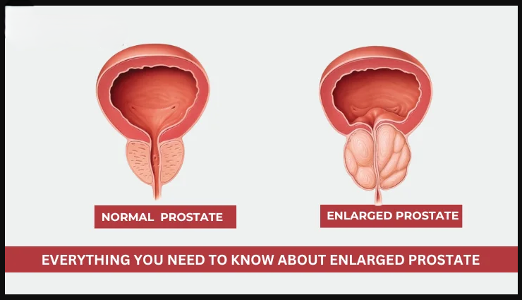 Understanding Prostate Enlargement: Symptoms and Treatments by the Best Urologist Doctor in Agra, Dr. Dilip Kumar Mishra