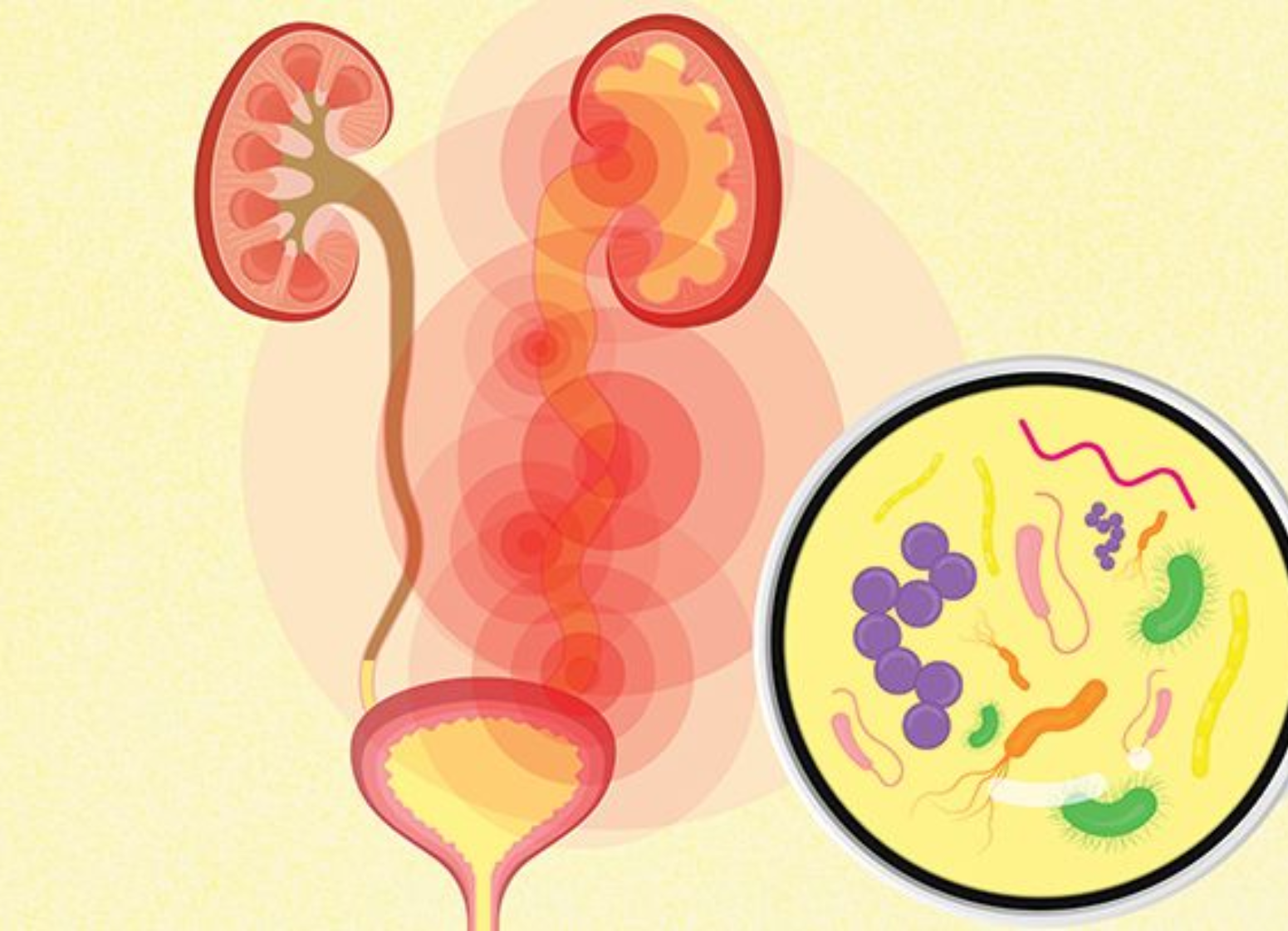 Urinary Tract Infections: Causes, Symptoms, and Prevention - Bosa ...