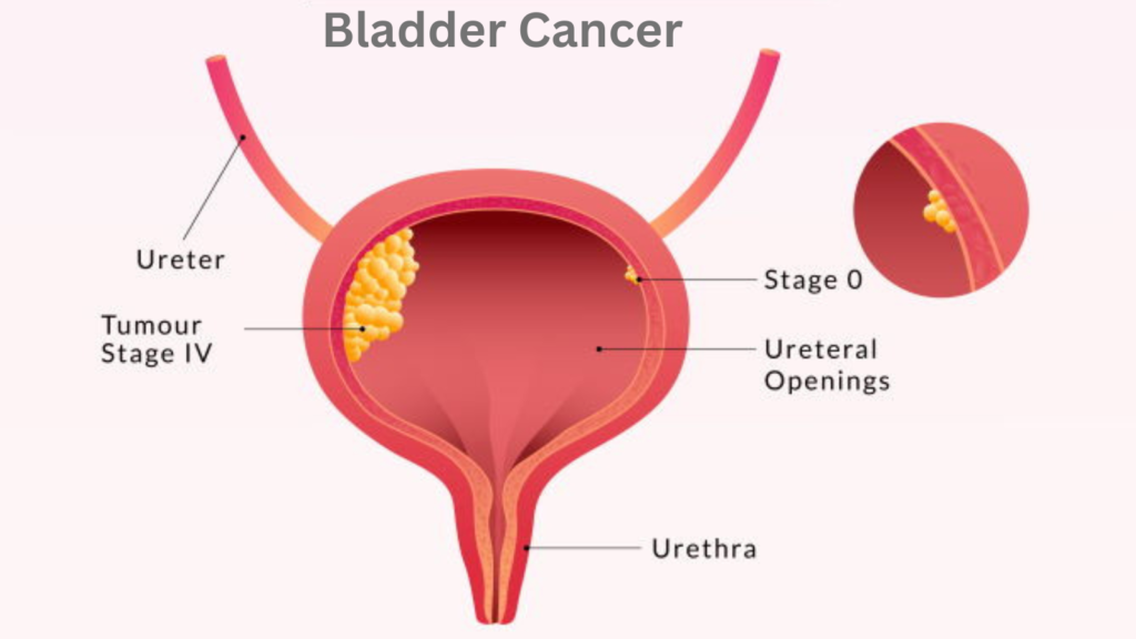 Early Signs of Bladder Cancer You Should Never Ignore| Urologist in Agra