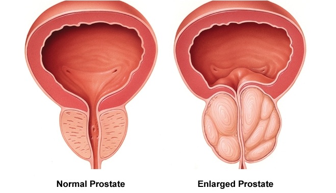 Laser Surgery for Your Prostate Swelling: A Modern Solution by a Sexologist in Agra