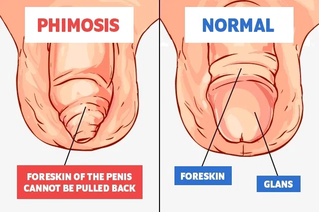 phimosis treatment in Agra