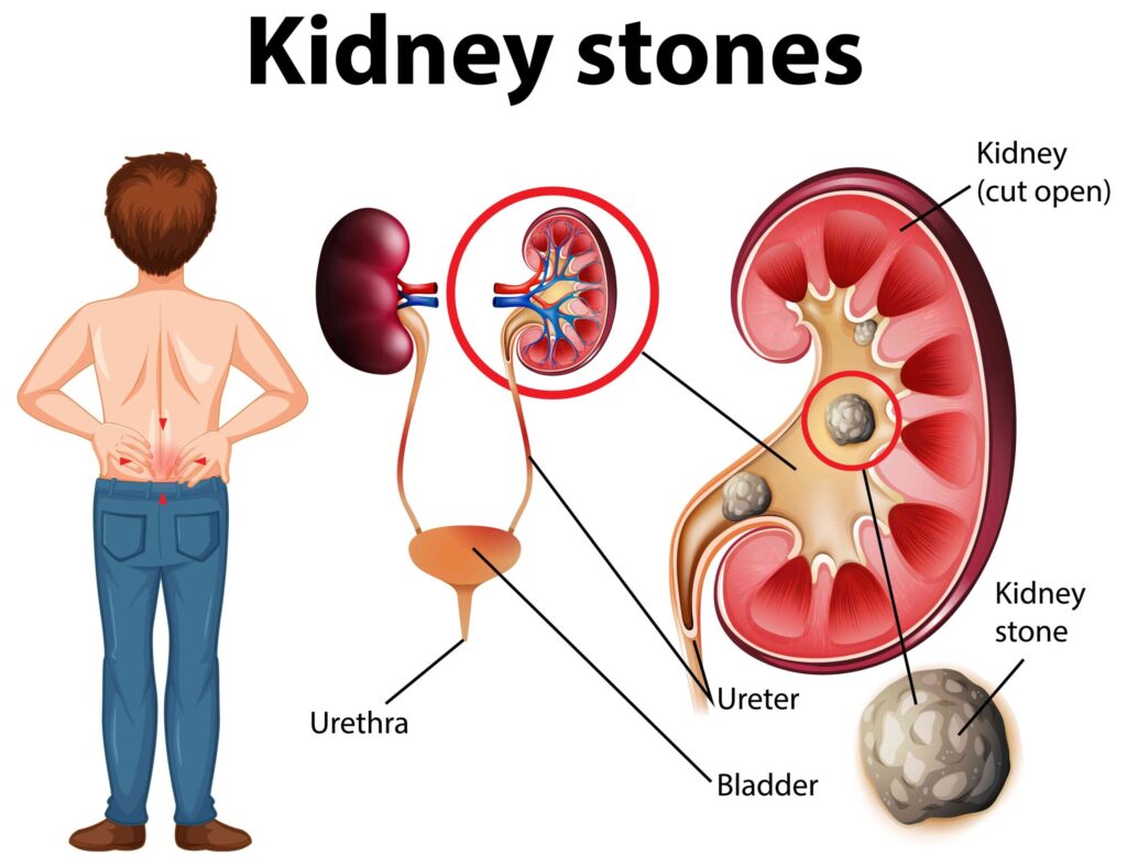 Kidney Stones Treatment in Agra — Causes, Symptoms & Laser Surgery by Dr. Dilip Mishra