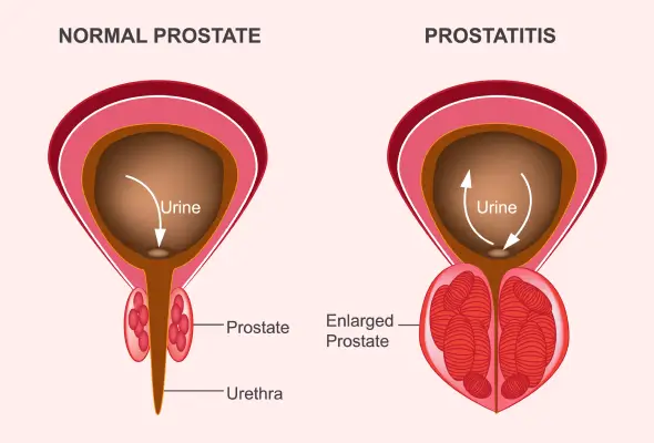 Understanding Prostate Enlargement — Expert Laser & Medical Treatment by Dr. Dilip Mishra, Urologist in Agra
